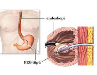 PERKÜTAN ENDOSKOPİK GASTROSTOMİ (PEG)